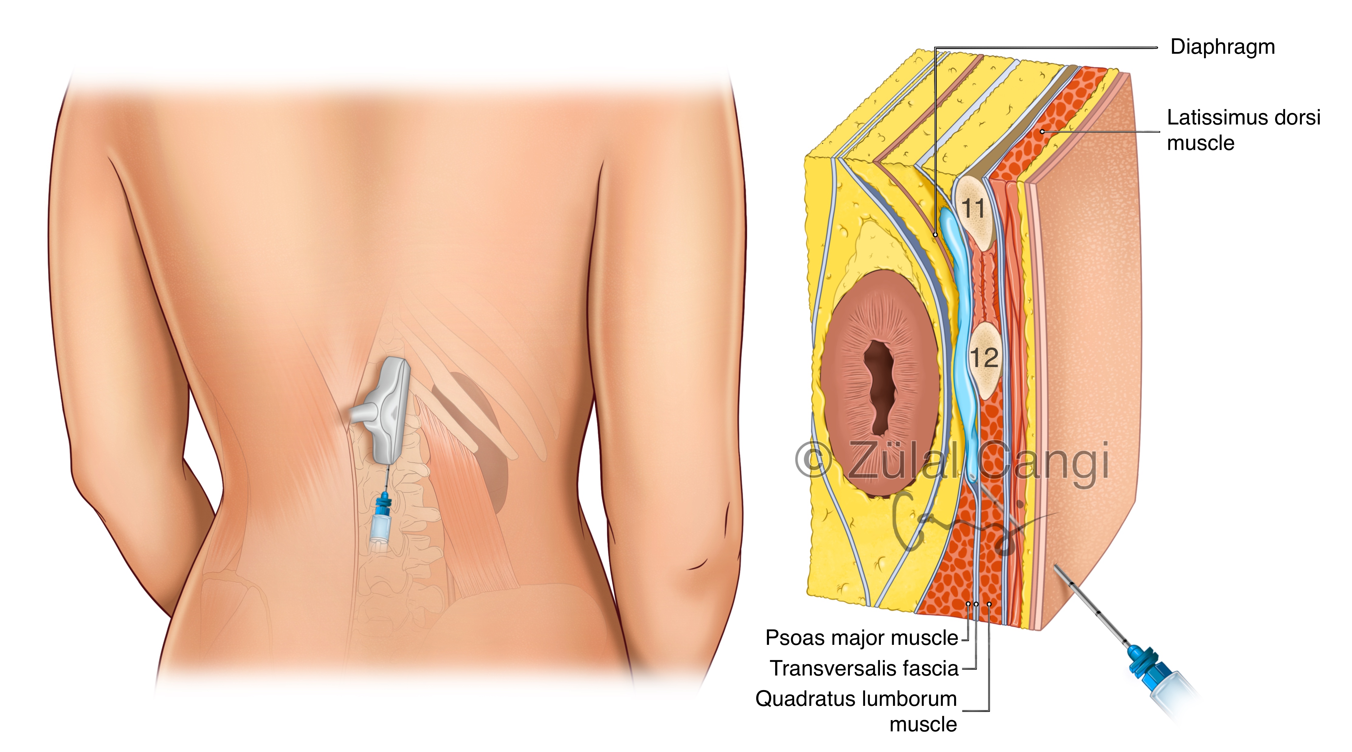 Transmuscular Quadratus Lumborum Block (QLB III)