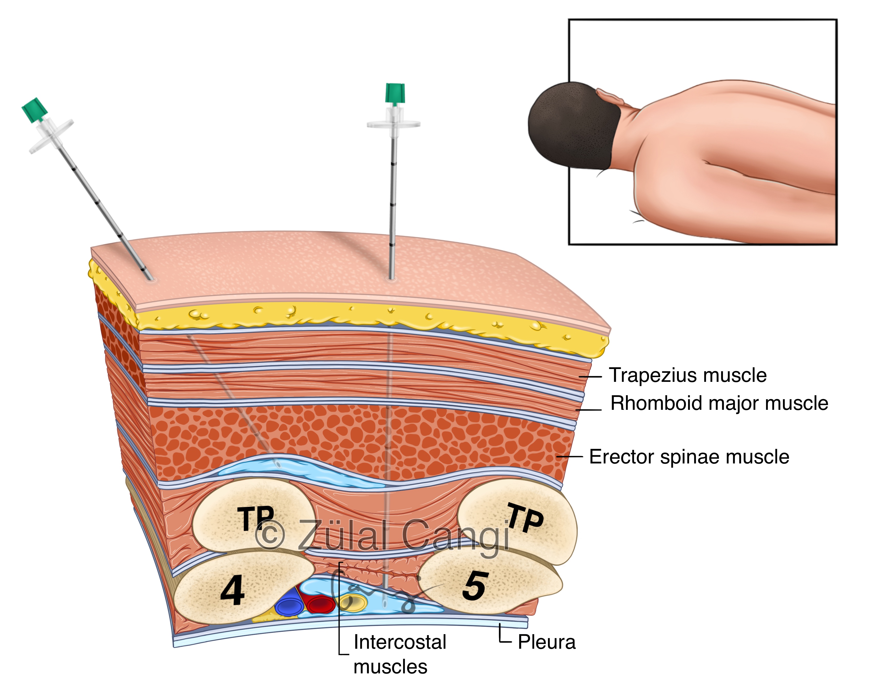 Intercostal Nerve Block (ICNB)